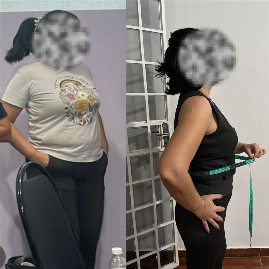 Foto de antes e depois de paciente, rosto preservado