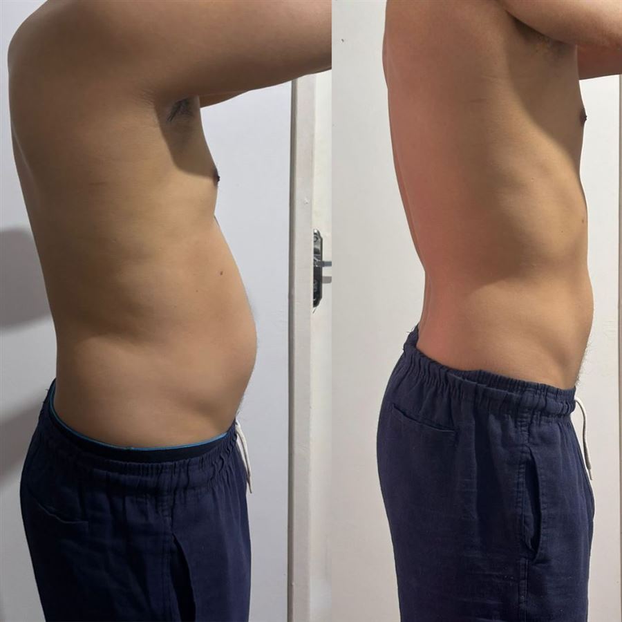 Foto de antes e depois de paciente, rosto preservado