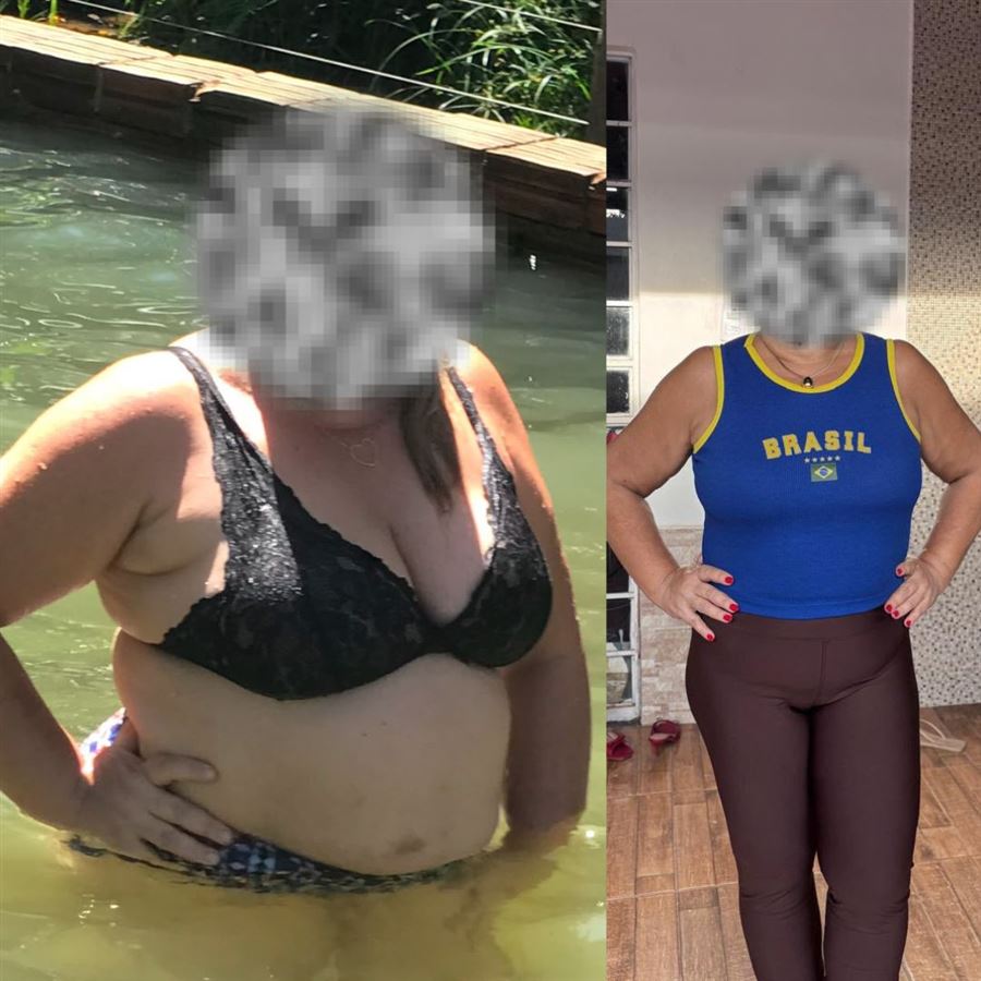 Foto de antes e depois de paciente, rosto preservado